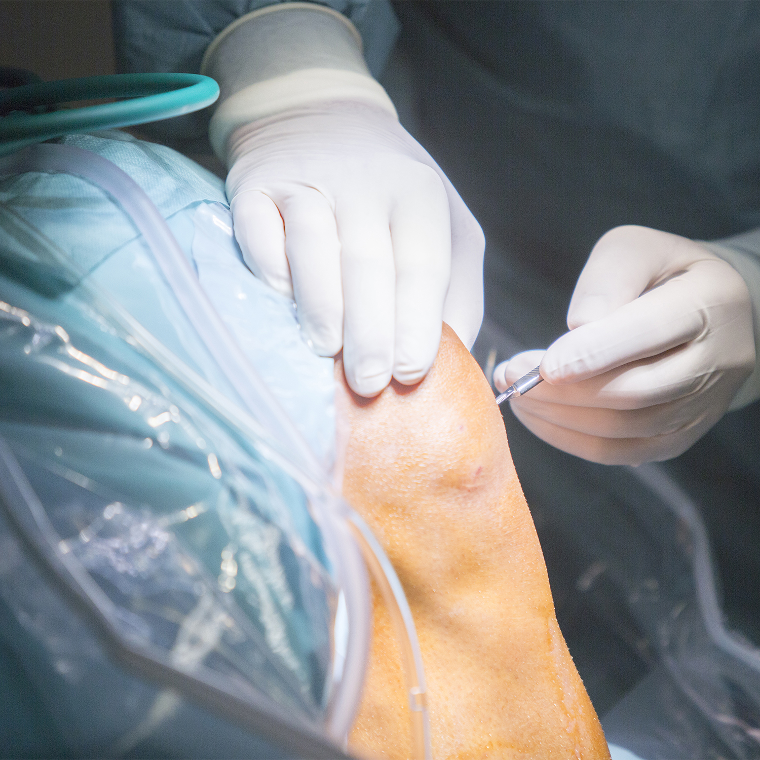 Plastia de ligamento cruzado